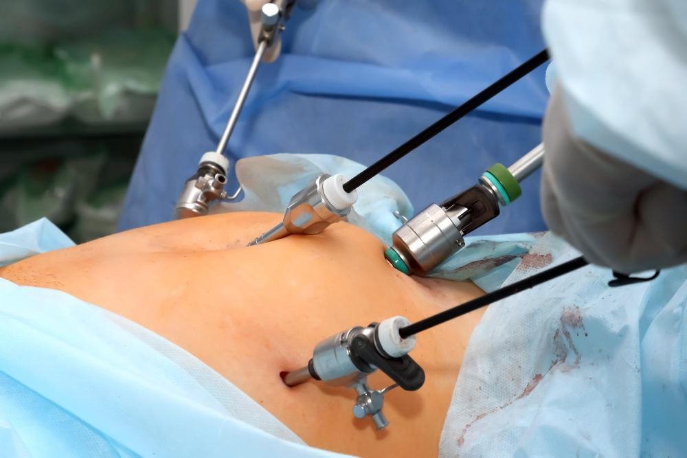 What-Is-Laparoscopic-Appendectomy