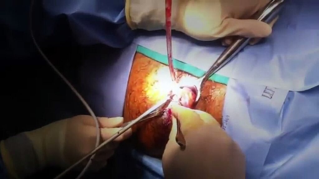 laser-Haemorrhoidectomy