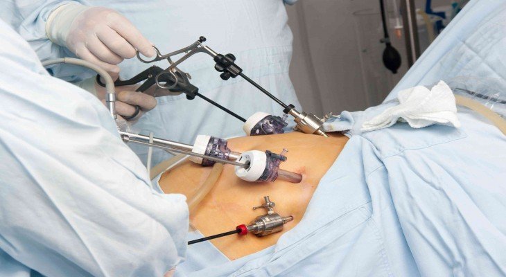 Expert laparoscopic surgeons performing bariatric surgery